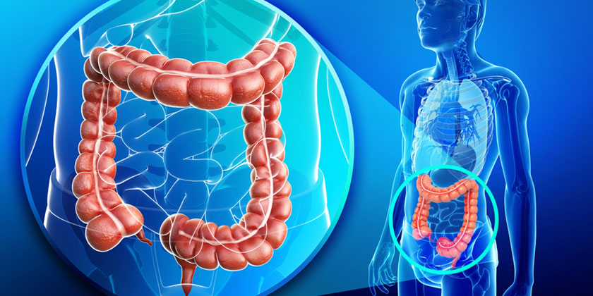 İltihabı barsak hastalıkları (Ülseratif Kolit, Crohn) 