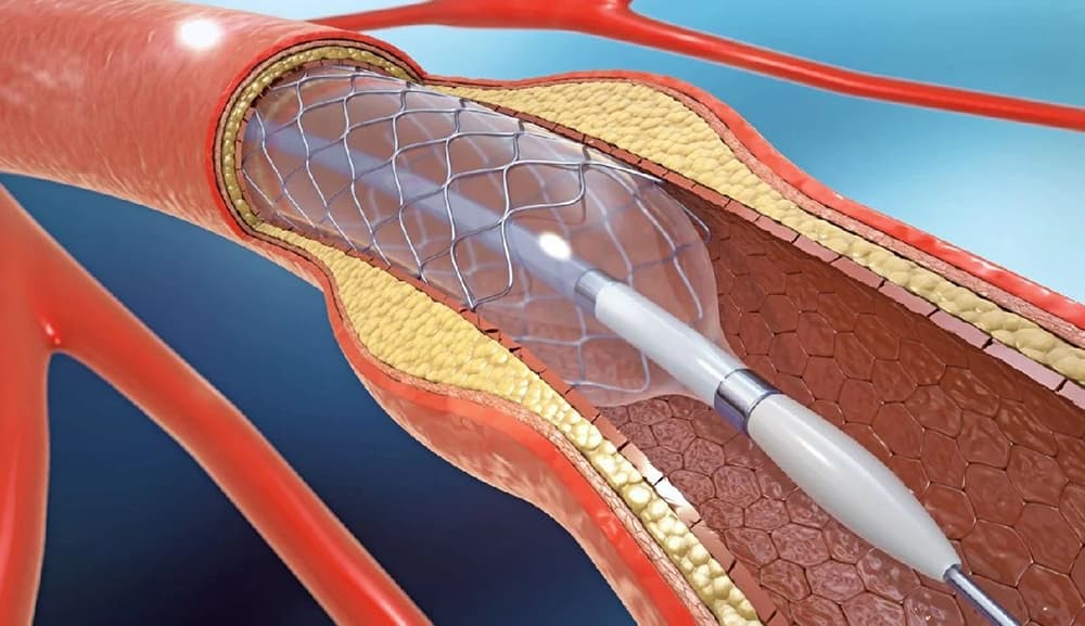 Gastrointestinal Sistem Balon ve Stent Uygulamaları 