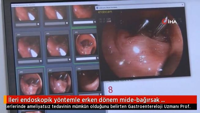 İleri endoskopik yöntemle erken dönem mide-bağırsak kanserinde yüzde 100 başarı